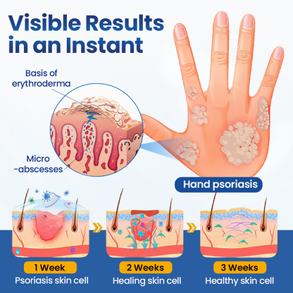 Mepilo® PsoriaMucin No-Rub Itch & Flake Relief Mist