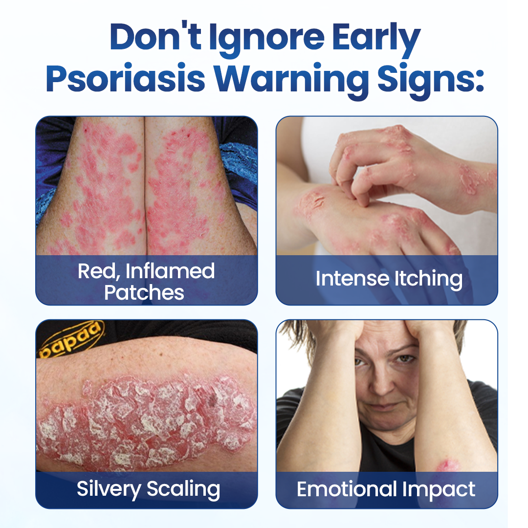 Mepilo® PsoriaMucin No-Rub Itch & Flake Relief Mist