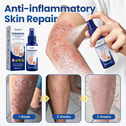 Mepilo® PsoriaMucin No-Rub Itch & Flake Relief Mist